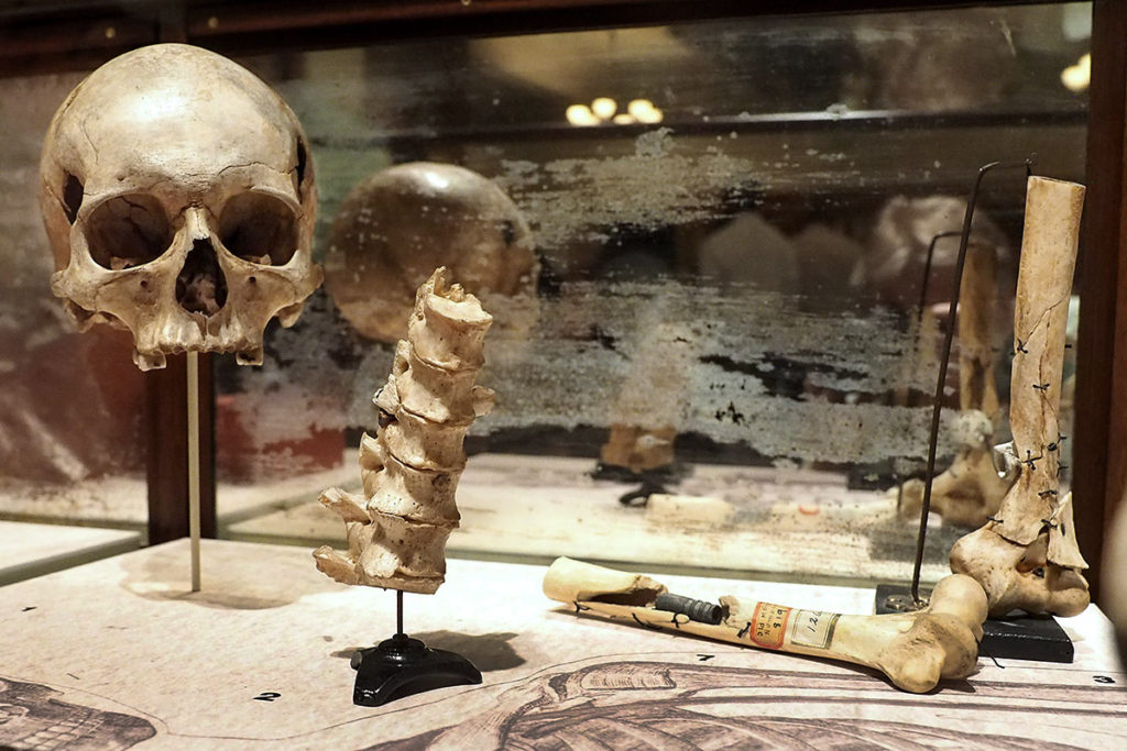 Bones of Civil War soldiers embedded with bullets